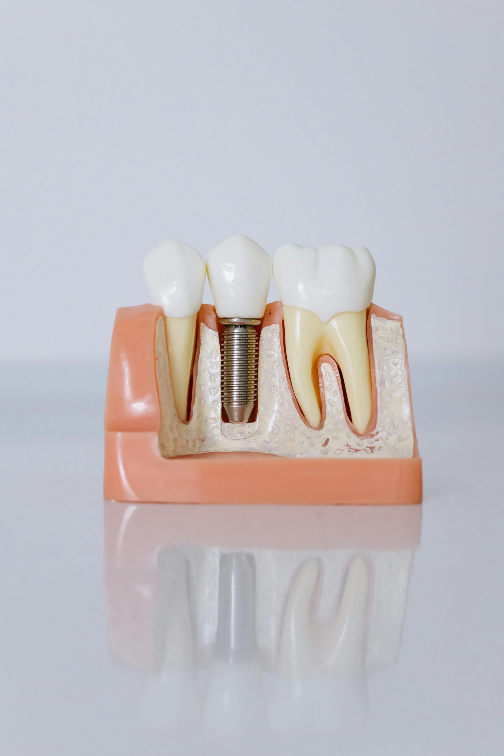 implantes-1pexels-cottonbro-6502306 implantes-1pexels-cottonbro-6502306